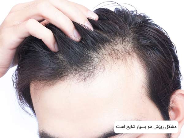 موی سر يک آقا که دچار ريزش شده است در پس زمينه سفيد.
