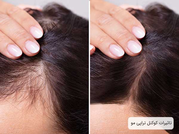تصوير قبل و بعد کوکتل تراپی موی سر يک خانم.