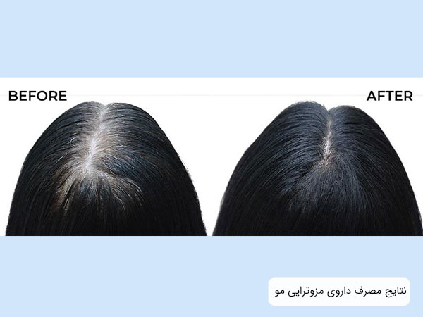 تاثير کوکتل مو بر پرپشت شدن موهای يک خانم.