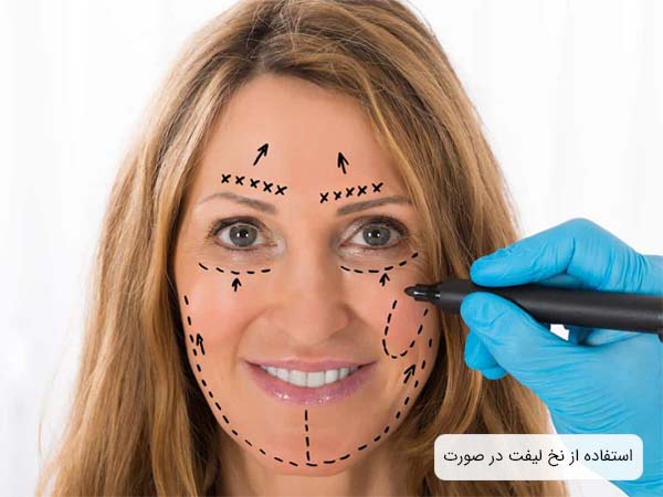 صورت يک خانم که با ماژيک علامت گذاری شده قبل از استفاده از نخ ليفت.