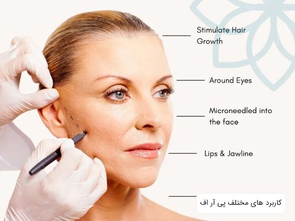 تزريق PRF به صورت يک خانم و کاربرد های پی آر اف که در پس زمينه نوشته شده است.