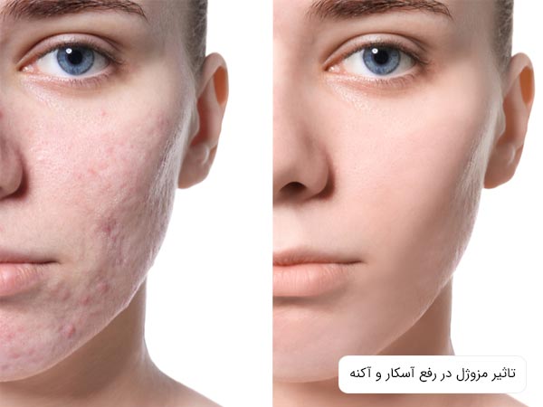 عکس قبل و بعد از تزريق مزوژل روی صورت براي رفع آکنه در پس زمينه سفيد.