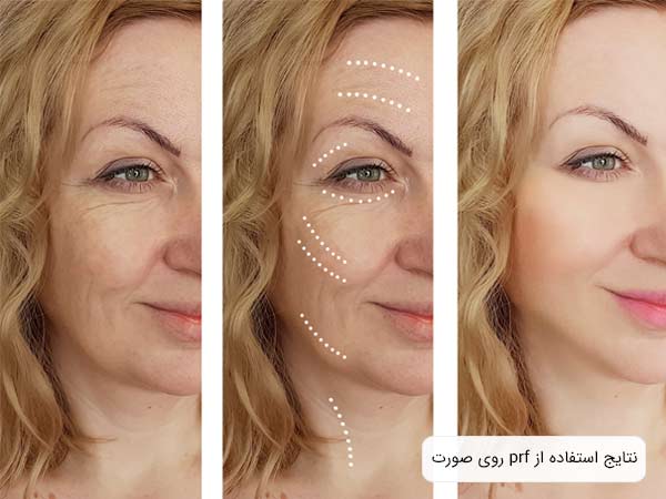 تاثيرات استفاده از پی آر اف روی صورت يک خانم.