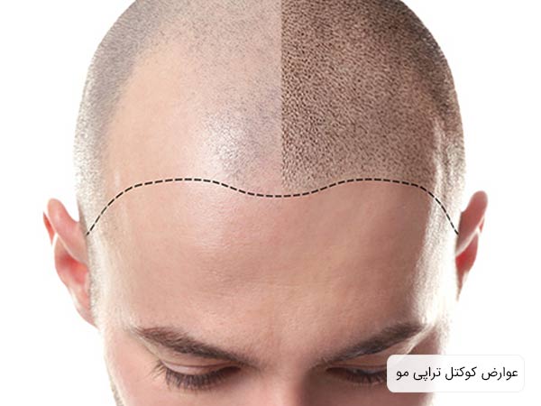 تصوير سر يک آقا بعد از مزوتراپی در پس زمينه سفيد.