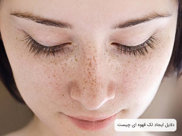 صورت يک خانم جوان که دچار لک های ريز پوستی شده است.