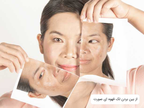 درمان لک های قهوه ای صورت يک خانم.
