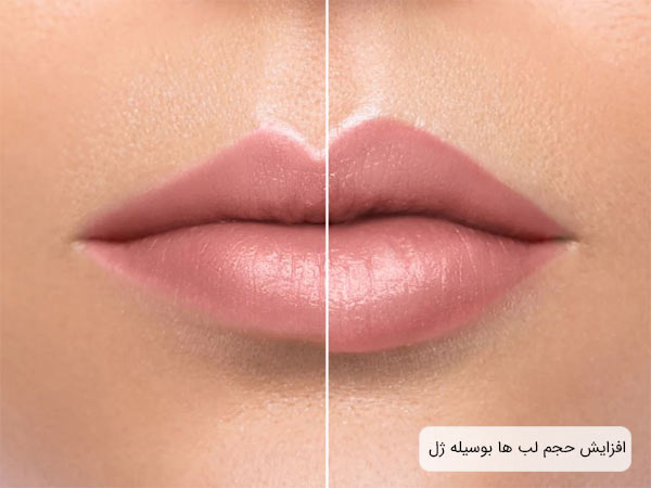 افزايش حجم لب ها بعد از تزريق ژل لب.