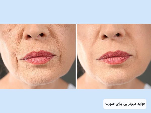 تاثيرات استفاده از کوکتل مزوتراپی آبرسان روی صورت يک خانم ميانسال.