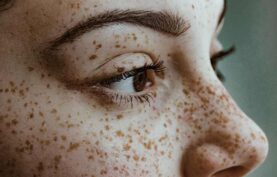 لک هاي قهوه ای ريز روی صورت يک خانم جوان.