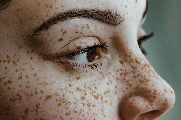 لک هاي قهوه ای ريز روی صورت يک خانم جوان.