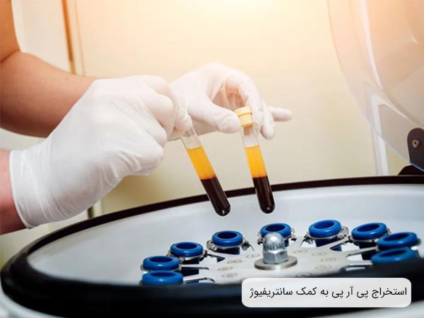 تهيه پی آر پی با استفاده از دستگاه سانتريفيوژ.