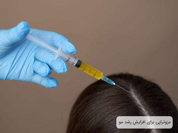 انجام مزوتراپی مو روی سر يک خانم توسط پزشک.