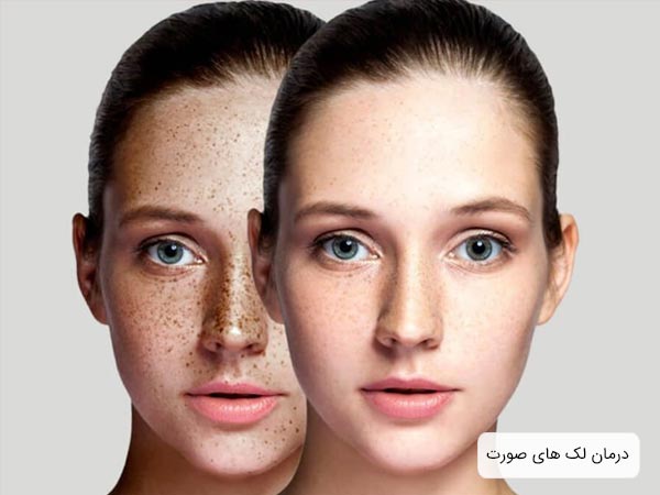 صورت يک خانم قبل و بعد از درمان لک های قهوه ای پوست.