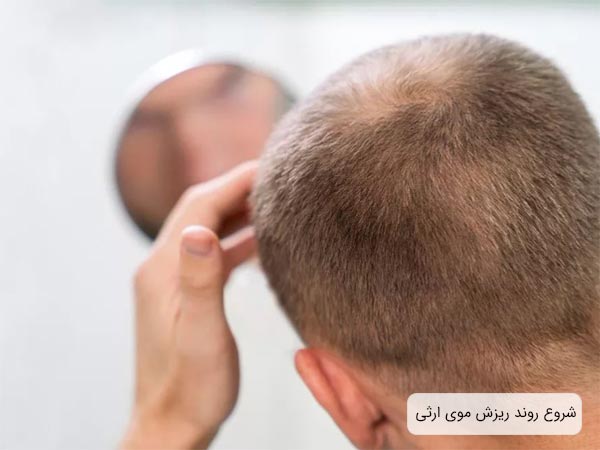 اوايل پروسه ريزش موی ارثی در يک آقا با موها بور و کوتاه که در حال نگاه کردن به آيينه است.