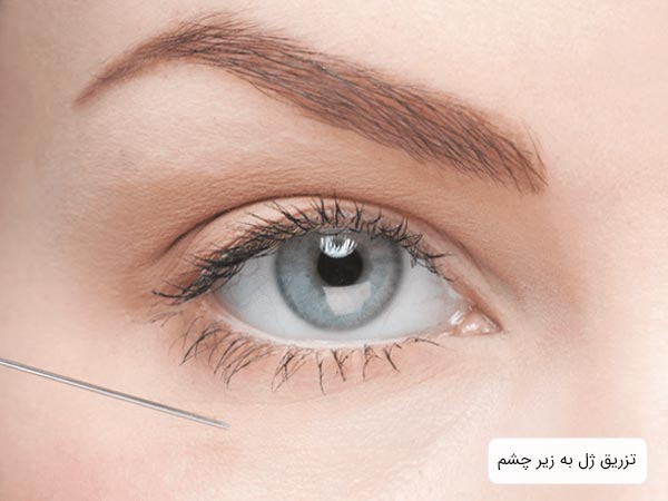 تزريق ژل و فيلر به زير چشم يک خانم با چشم هاي آبی.