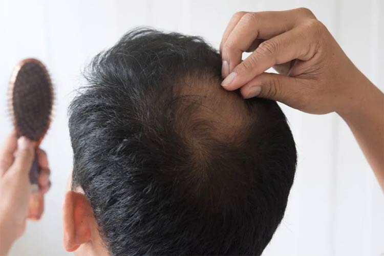 ريزش موی ارثی در يک آقا با مو های مشکی رنگ که يک شانه در دستش گرفته است.