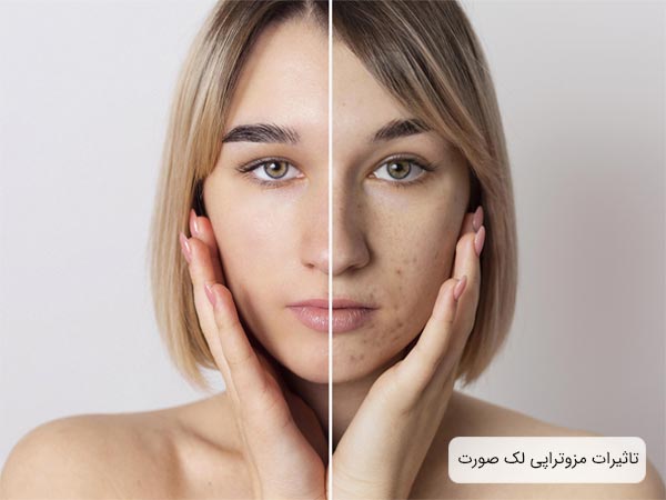 بهبود لک های صورت يک خانم جوان بعد از انجام مزوتراپی.