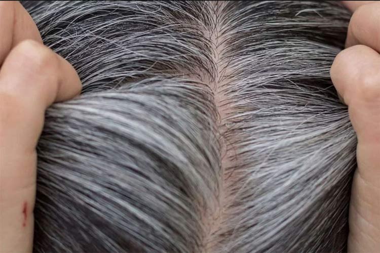 مو های سفيد و سياه يا به اصطلاح جو گندمی در سر.