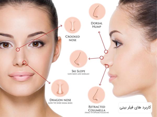 کاربرد فيلر بينی به صورت عکس های کوچک در کنار صورت يک خانم قرار داده شده است.