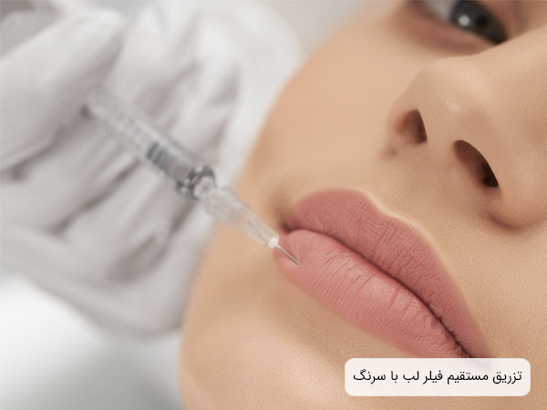 تزريق فيلر لب به لب يک خانم توسط متخصص.