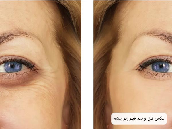 پوست زير چشم يک خانم قبل و بعد از تزريق فيلر.