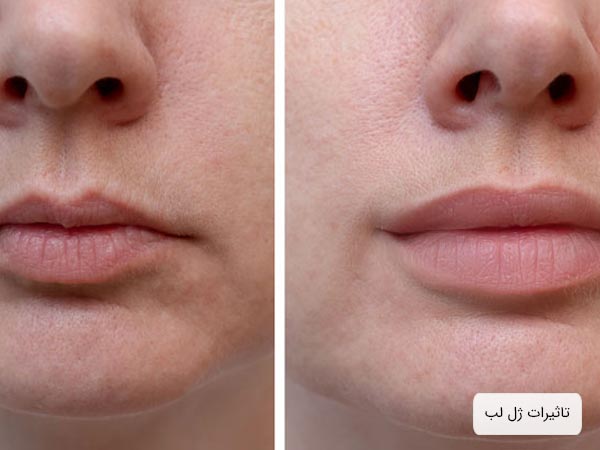 عکس قبل و بعد تزريق ژل لب يک خانم.