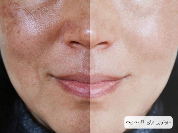 عکس قبل و بعد درمان لک صورت و روشن سازي پوست.