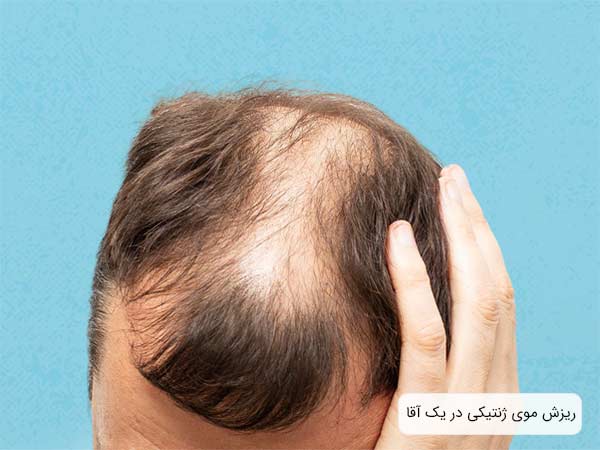سر يک آقا که دچار ريزش موی ارثی شده است با پس زمينه آبی رنگ.