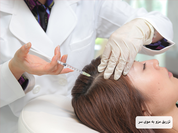 تزریق کوکتل مزوتراپی به موی سر یک خانم توسط پزشک.