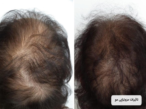 عکس قبل و بعد مزوتراپی موی سر.