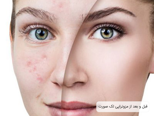 تاثيرات مثبت مزوتراپی در از بين بردن لک های صورت يک خانم.