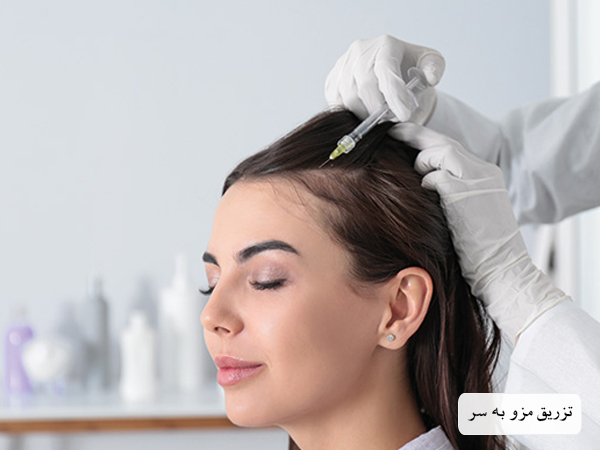 تزریق کوکتل مزو مو به سر یک خانم توسط پزشک.