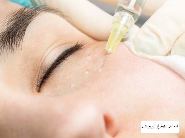 تزریق مزو زیرچشم به ناحیه مورد نظر.