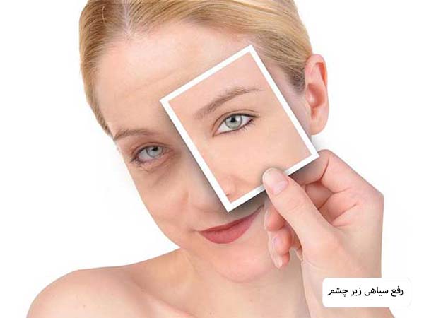 رفع مشکلات پوستی اطراف چشم یک خانم.