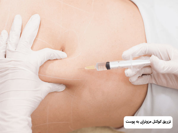 تزریق کوکتل لاغری به شکم یک خانم توسط متخصص.