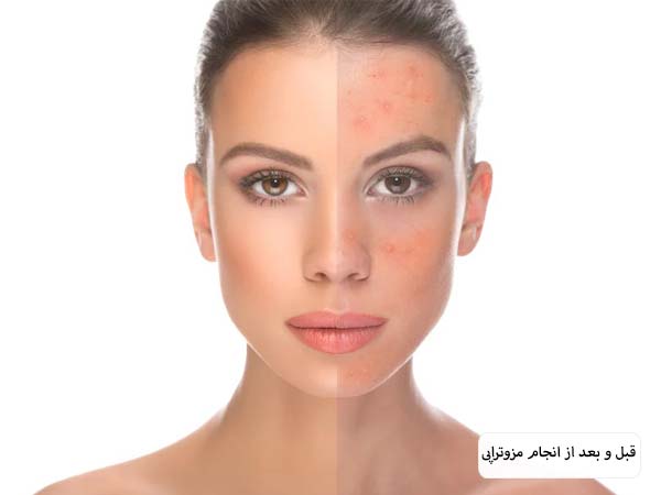 صورت یک خانم قبل و بعد از انجام مزوتراپی