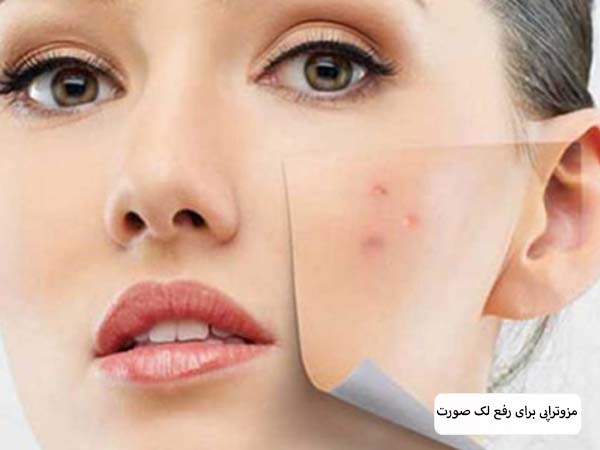 صورت یک خانم بعد از انجام مزوتراپی