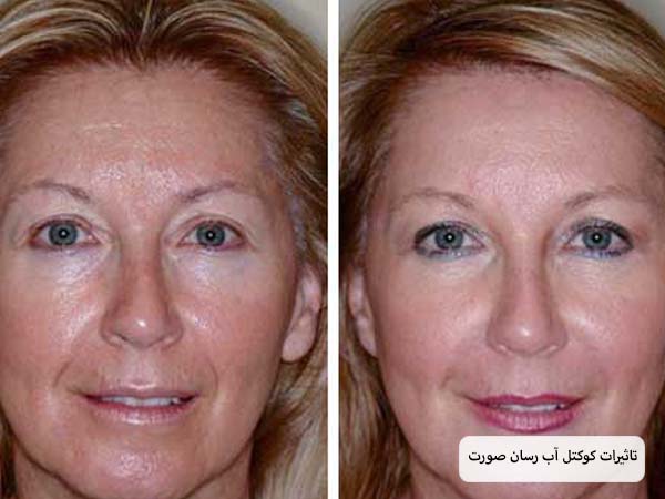 صورت یک خانم قبل و بعد از انجام مزوتراپی.
