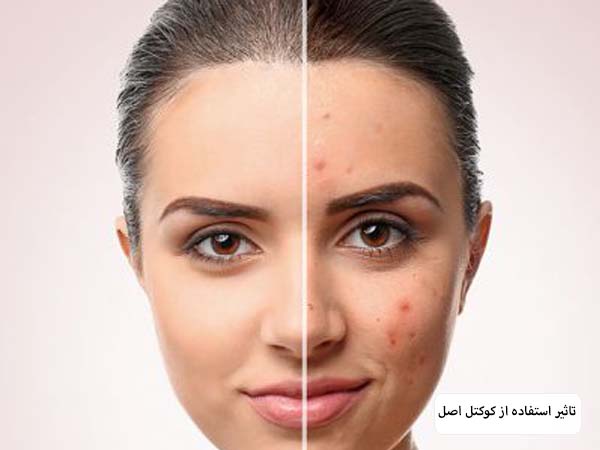 صورت یک خانم قبل و بعد از انجام مزوتراپی لک