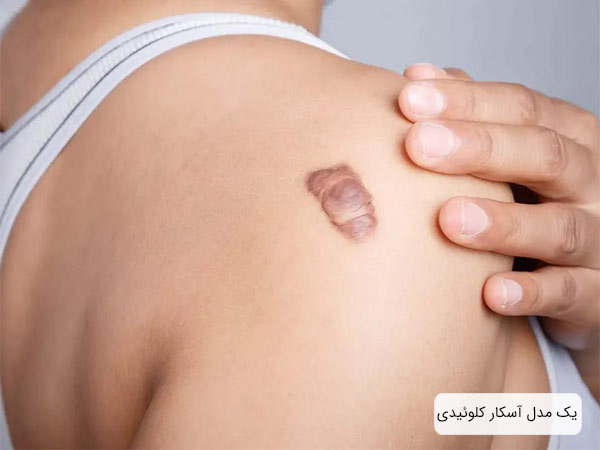يک نمونه اسکار کلوئيدی يا گوشت اضافه روی پوست.