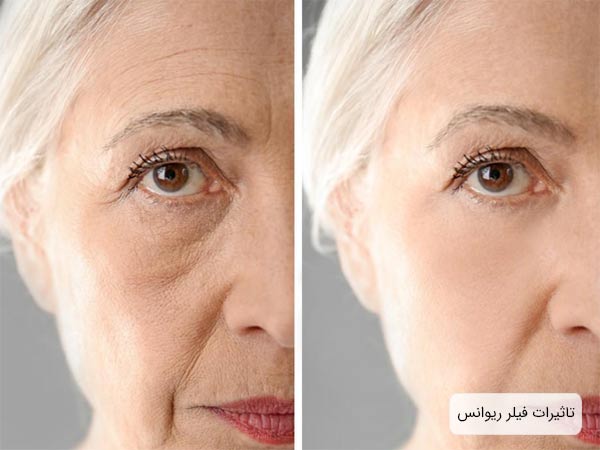 عکس قبل و بعد استفاده از فيلر ريوانس روي صورت يک خانم.