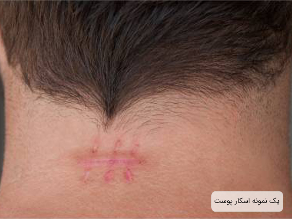 اسکار پوست روی پشت گردن يک آقا.