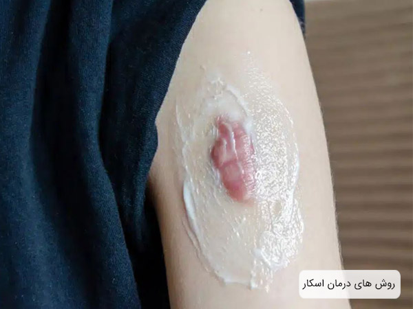 استفاده از کرم روي محل اسکار.