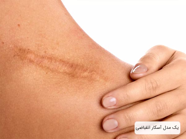يک نمونه آسکار انقباضی روی شانه.