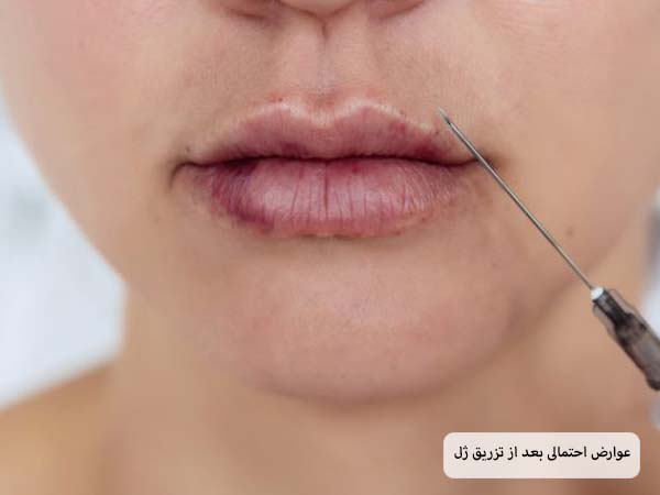 لب های یک خانم که بعد از تزریق ژل دچار التهاب و کبودی شده است.