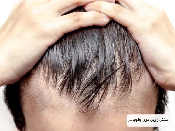 ریزش مو های جلوی سر یک آقا در پس زمینه سفید.