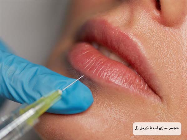 تزریق ژل لب به لب های یک زیبا جو توسط متخصص.