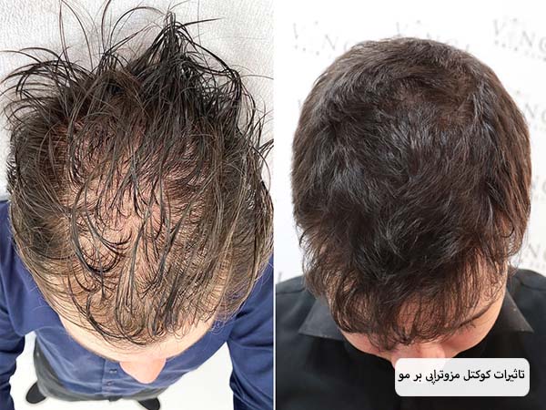 افزایش رشد مو ها در سر یک آقا بعد از انجام مزوتراپی.