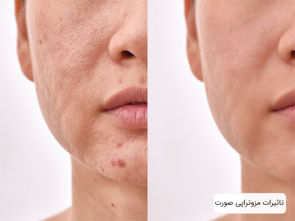 نتايج انجام مزوتراپی روي پوست صورت يک خانم در پس زمينه سفيد.