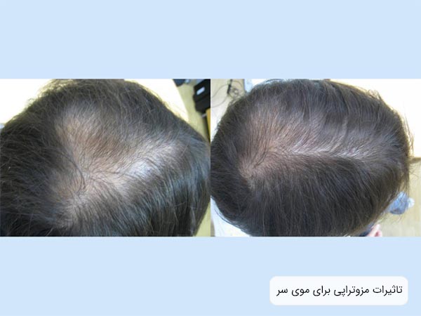 مو هاي سر يک آقا قبل و بعد از انجام مزوتراپی